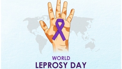 World Leprosy Day 2023: Expert debunks Hansen’s disease myths, shares facts to battle leprosy (Photo by Twitter/skinskapharma) World Leprosy Day 2023: Expert debunks Hansen’s disease myths, shares facts to battle leprosy (Photo by Twitter/skinskapharma)