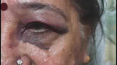 Senior citizen suffers injuries as scooter hits pothole Senior citizen suffers injuries as scooter hits pothole