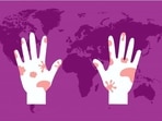 Can leprosy be transmitted by physical contact? (Photo by Twitter/EmbaCubaJamaica) Can leprosy be transmitted by physical contact? (Photo by Twitter/EmbaCubaJamaica)