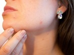 Skincare experts debunk acne myths (Image by Kjerstin Michaela Noomi Sakura Gihle Martinsen Haraldsen from Pixabay ) Skincare experts debunk acne myths (Image by Kjerstin Michaela Noomi Sakura Gihle Martinsen Haraldsen from Pixabay )