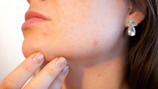 Skincare experts debunk acne myths (Image by Kjerstin Michaela Noomi Sakura Gihle Martinsen Haraldsen from Pixabay )