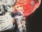 Brain_x-ray Brain_x-ray