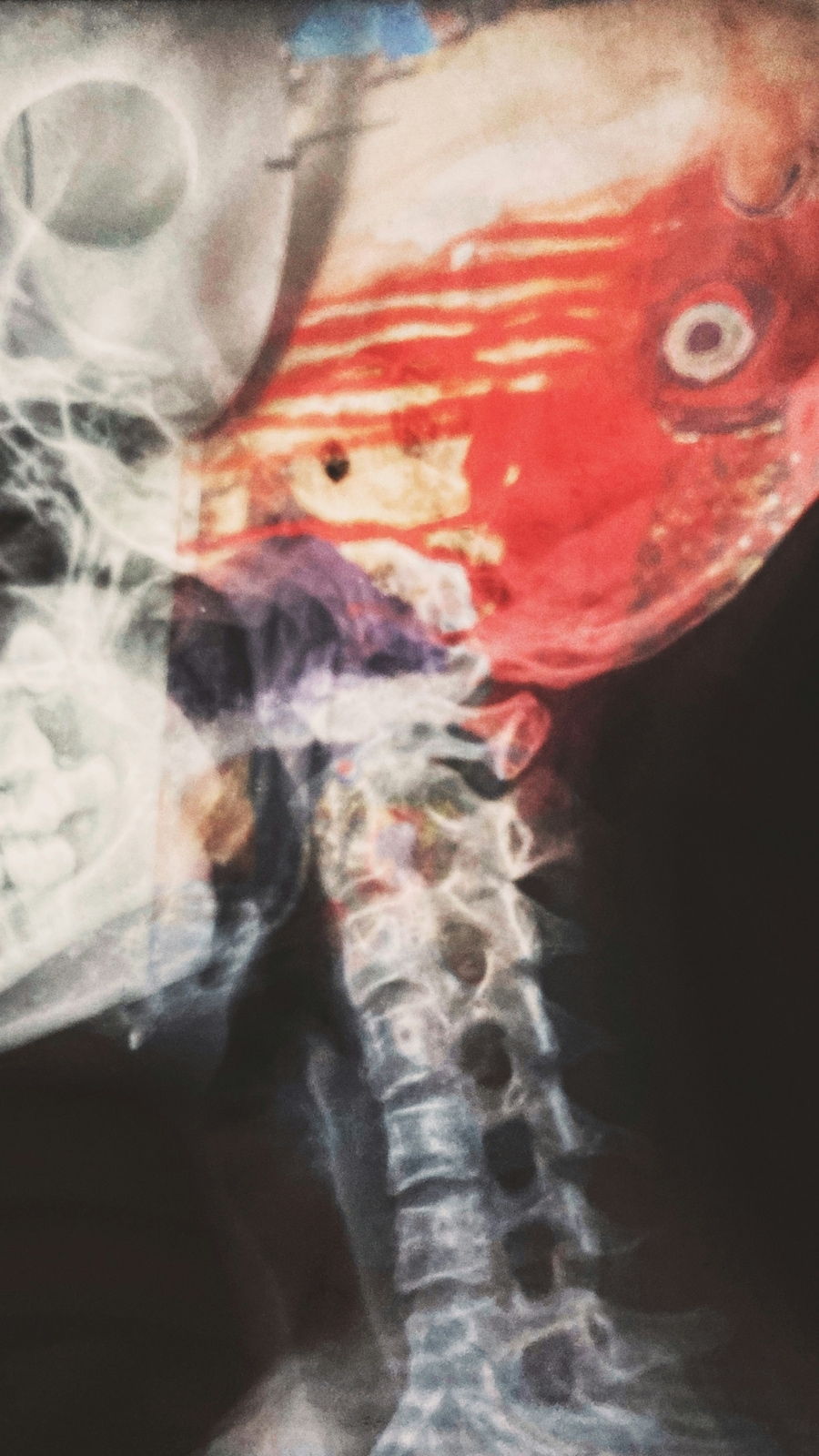 Brain_x-ray
