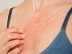 Scabies is a type of skin allergy which is characterised by intense itching and rash.(Unsplash) Scabies is a type of skin allergy which is characterised by intense itching and rash.(Unsplash)