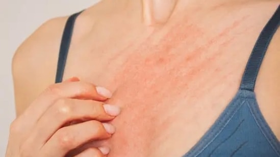 Scabies is a type of skin allergy which is characterised by intense itching and rash.(Unsplash)