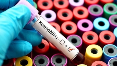 Haemophilia: Causes and advancements in treatment that you should know (File Photo) Haemophilia: Causes and advancements in treatment that you should know (File Photo)