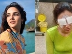 Actor Jasmin Bhasin has shared how her eyes were severely affected due to contact lenses. Actor Jasmin Bhasin has shared how her eyes were severely affected due to contact lenses.