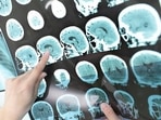 The common symptoms of multiple sclerosis include numbness or weakness in limbs, tingling, electric-shock-like sensations with neck movements, lack of coordination, partial or complete vision loss with eye pain, prolonged double vision, blurry vision, and vertigo.(Shutterstock) The common symptoms of multiple sclerosis include numbness or weakness in limbs, tingling, electric-shock-like sensations with neck movements, lack of coordination, partial or complete vision loss with eye pain, prolonged double vision, blurry vision, and vertigo.(Shutterstock)
