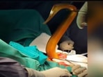 A 2-foot eel was removed from the man's abdomen in Vietnam.(Facebook/Viet Duc University Hospital) A 2-foot eel was removed from the man's abdomen in Vietnam.(Facebook/Viet Duc University Hospital)