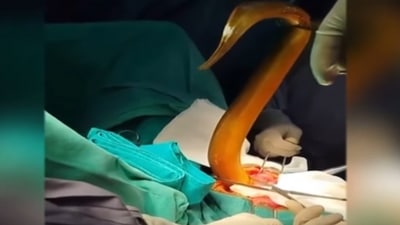 A 2-foot eel was removed from the man's abdomen in Vietnam. (Facebook/Viet Duc University Hospital) A 2-foot eel was removed from the man's abdomen in Vietnam. (Facebook/Viet Duc University Hospital)