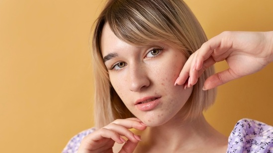 Acne formation, facial hair and hair loss are often associated with high testosterone levels. (Image by Freepik)