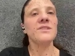 California nurse Brianna Solari kicked off Southwest Airlines flight because of her skin condition (WCNC screenshot/YouTube)