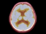 “One of the most serious complications of lung cancer is its potential to metastasise to other critical parts of the body, particularly the brain, “One of the most serious complications of lung cancer is its potential to metastasise to other critical parts of the body, particularly the brain,