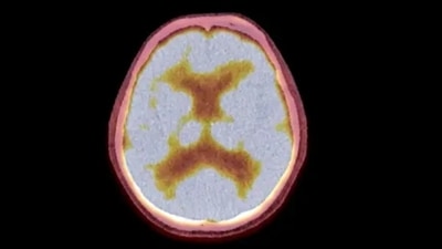 “One of the most serious complications of lung cancer is its potential to metastasise to other critical parts of the body, particularly the brain," said Dr Praveen Gupta. (Unsplash) “One of the most serious complications of lung cancer is its potential to metastasise to other critical parts of the body, particularly the brain," said Dr Praveen Gupta. (Unsplash)