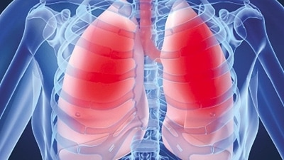 TB is a serious infectious disease that mainly affects lungs but can also affect bones, brain or other parts of the body. (Representative image) TB is a serious infectious disease that mainly affects lungs but can also affect bones, brain or other parts of the body. (Representative image)