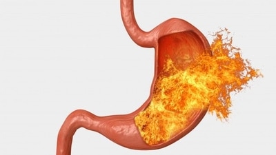 Acid reflux management guide: Causes, symptoms, effective treatment options  and prevention tips | Health