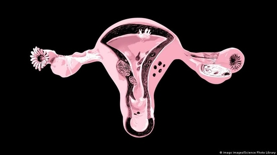In PCOS, testosterone levels and Androgen levels are usually high. This can further contribute to ADHD.&nbsp;(imago images/Science Photo Library)
