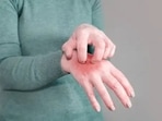 Skin diseases are running rampant in Gaza, health officials say.(Unsplash) Skin diseases are running rampant in Gaza, health officials say.(Unsplash)