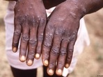 Mpox is transmitted through close physical contact, and the most noticeable symptom of the disease is pus-filled lesions on the skin.(AP/picture alliance) Mpox is transmitted through close physical contact, and the most noticeable symptom of the disease is pus-filled lesions on the skin.(AP/picture alliance)