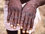 Mpox is transmitted through close physical contact, and the most noticeable symptom of the disease is pus-filled lesions on the skin.(AP) Mpox is transmitted through close physical contact, and the most noticeable symptom of the disease is pus-filled lesions on the skin.(AP)