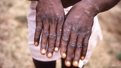 Mpox is transmitted through close physical contact, and the most noticeable symptom of the disease is pus-filled lesions on the skin. (AP) Mpox is transmitted through close physical contact, and the most noticeable symptom of the disease is pus-filled lesions on the skin. (AP)
