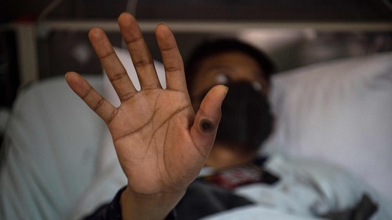 Patient showing his hand with a sore caused by an infection of the monkeypox virus in Lima, Peru.(AFP / File)