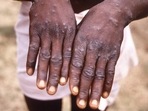 Mpox is transmitted through close physical contact, and the most noticeable symptom of the disease is pus-filled lesions on the skin. Mpox is transmitted through close physical contact, and the most noticeable symptom of the disease is pus-filled lesions on the skin.