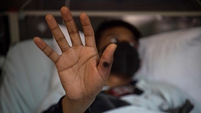 The U.N. health agency declared a global health emergency for mpox this week after a huge outbreak in Democratic Republic of Congo spread into nearby countries. (AFP / File)