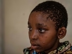 A young girl suffering from Mpox waits for treatment at a centre in Munigi, eastern Congo. (AP) A young girl suffering from Mpox waits for treatment at a centre in Munigi, eastern Congo. (AP)
