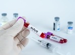 Mpox virus outbreak in the African region, WHO declares it a public emergency.(Shutterstock) Mpox virus outbreak in the African region, WHO declares it a public emergency.(Shutterstock)