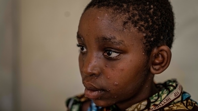 A young girl suffering from Mpox waits for treatment at a centre in Munigi, eastern Congo. (AP) A young girl suffering from Mpox waits for treatment at a centre in Munigi, eastern Congo. (AP)