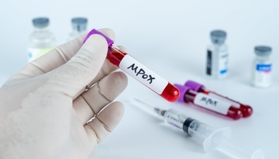 Mpox virus outbreak in the African region, WHO declares it a public emergency. (Shutterstock) Mpox virus outbreak in the African region, WHO declares it a public emergency. (Shutterstock)