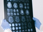 New treatment target can prevent Alzheimer’s. (Pexels) New treatment target can prevent Alzheimer’s. (Pexels)