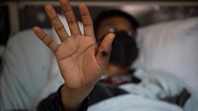 A patient showing his hand with a sore caused by an infection of the monkeypox virus, in the isolation area for monkeypox patients at the Arzobispo Loayza hospital, in Lima, Peru. (AFP/File)