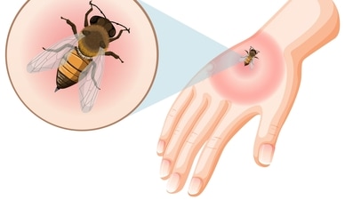 Mosquito-borne diseases like malaria, dengue, and Zika pose severe health threats, with millions affected annually and evolving drug-resistant strains complicating treatments. (Freepik) Mosquito-borne diseases like malaria, dengue, and Zika pose severe health threats, with millions affected annually and evolving drug-resistant strains complicating treatments. (Freepik)