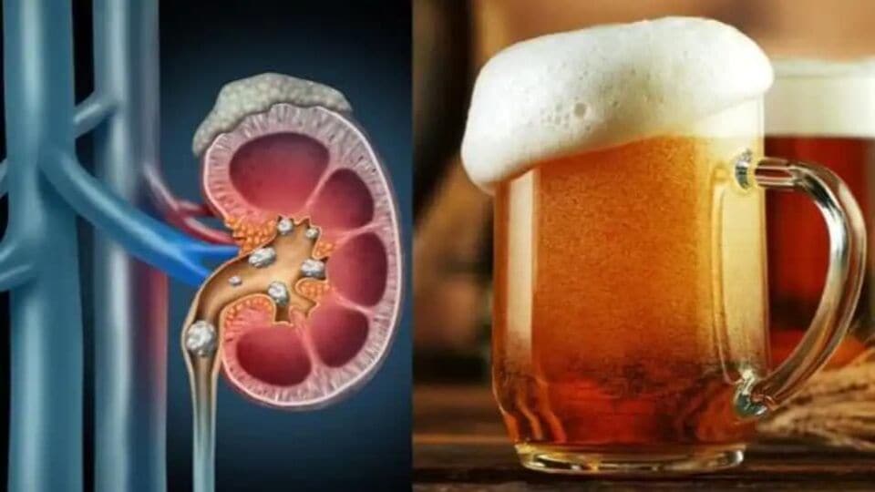 Beer for Kidney Stones ಬಿಯರ್ ಕುಡಿದ್ರೆ ಕಿಡ್ನಿ ಸ್ಟೋನ್ ಹೋಗುತ್ತಾ? ಇದು