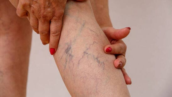 ಕಾಲುಗಳಲ್ಲಿನ ರಕ್ತನಾಳಗಳ ಊತದ (ವೆರಿಕೋಸ್​ ವೇನ್ಸ್​) ಸಮಸ್ಯೆಗೂ ಕಾರಣವಾಗಬಹುದು. ಹೀಗಾಗಿ ನಿಮ್ಮ ಕೆಲಸದ ಅವಧಿಯಲ್ಲಿ ಆಗಾಗ ಬ್ರೇಕ್​ ತೆಗದುಕೊಂಡು ನಡೆದಾಡುತ್ತಿರಿ. ದಿನಕ್ಕೆ ಒಂದು ಗಂಟೆಯಾದರೂ ವ್ಯಾಯಾಮ, ವಾಕಿಂಗ್​, ಜಾಗಿಂಗ್​ ಮಾಡಿ.&nbsp;