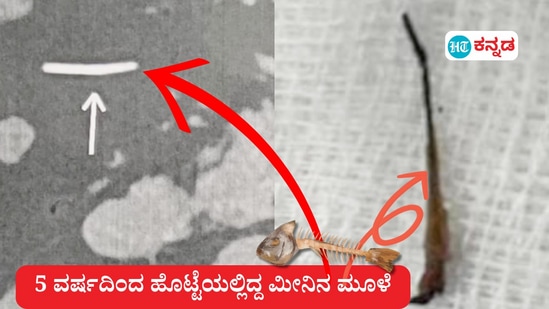 ಪದೇಪದೇ ಹೊಟ್ಟೆ ನೋವು ಅನುಭವಿಸಿದ್ದ 61 ವರ್ಷದ ವ್ಯಕ್ತಿಯ ಹೊಟ್ಟೆಯಲ್ಲಿತ್ತು ಈ ಮೀನು ಮುಳ್ಳು. 5 ವರ್ಷದಿಂದ ಹೊಟ್ಟೆಯಲ್ಲಿದ್ದ 2ಸೆಂ.ಮೀ. ಉದ್ದದ ಮೀನು ಮುಳ್ಳನ್ನು ಬೆಂಗಳೂರು ವೈದ್ಯರು ಹೊರ ತೆಗೆದಿದ್ದಾರೆ. 