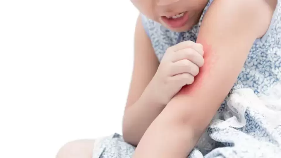 rash-in-children