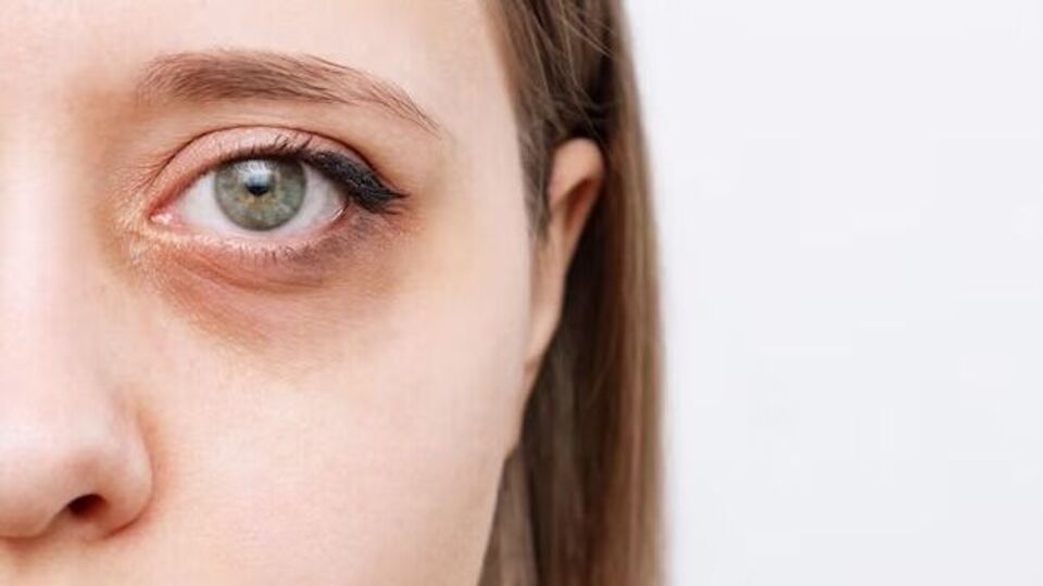 Dark Circles डोळ्यांखालील डार्क सर्कल आणि सुरकुत्या कशा कमी करायच्या
