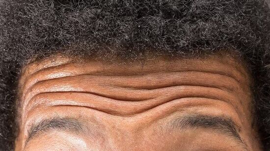 Pigmentation  