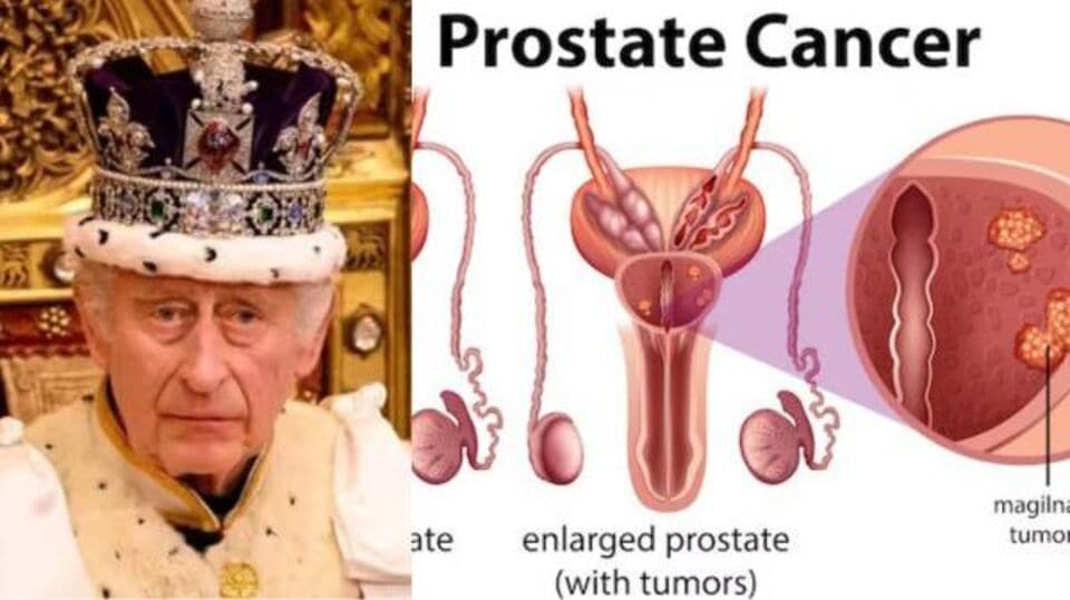 prostate-cancer