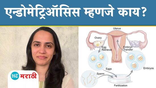 एन्डोमेट्रिऑसिस म्हणजे काय एन्डोमेट्रिऑसिस म्हणजे काय