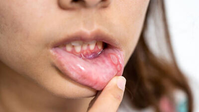 mouth ulcers due to the heat