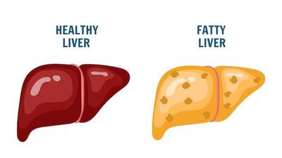 Fatty liver problem is increasing rapidly in youth 