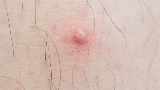 boils on skin