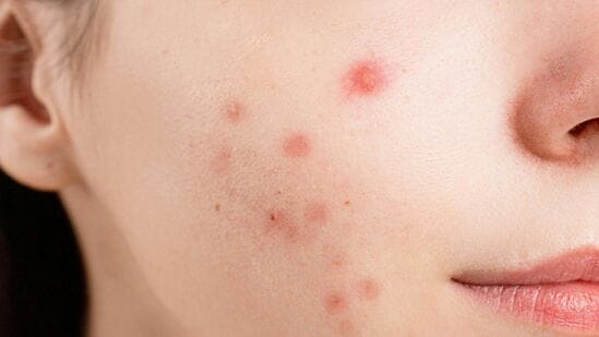 सामान्यत: त्वचेच्या आरोग्याची काळजी घेतली नाही तर त्यावर तेल, घाण, डेड स्किन आणि त्वचेचा थर जमा होऊ लागतो, ज्यामुळे छिद्रे बंद होतात आणि मुरुमांच्या समस्या उद्भवतात. संशोधनात असे सूचित केले गेले आहे की बंद छिद्रे जीवाणूंच्या वाढीसाठी अनुकूल परिस्थिती निर्माण करतात. ज्यामुळे त्वचेवर ब्लॅकहेड्स, व्हाइटहेड्स आणि मुरुमांच्या समस्या उद्भवतात. परंतु गरोदरपणात हार्मोन्स, ताणतणाव, आहार आणि औषधे, होणाऱ्या बदलांमुळे गरोदर महिलेच्या पाठीवर, मानेवर आणि कपाळावरही मुरुम येऊ शकतात. गर्भधारणेदरम्यान शरीरात इस्ट्रोजेन हार्मोन्सची पातळी वाढते, ज्यामुळे तेलग्रंथी अधिक तेल तयार करतात. सामान्यत: त्वचेच्या आरोग्याची काळजी घेतली नाही तर त्यावर तेल, घाण, डेड स्किन आणि त्वचेचा थर जमा होऊ लागतो, ज्यामुळे छिद्रे बंद होतात आणि मुरुमांच्या समस्या उद्भवतात. संशोधनात असे सूचित केले गेले आहे की बंद छिद्रे जीवाणूंच्या वाढीसाठी अनुकूल परिस्थिती निर्माण करतात. ज्यामुळे त्वचेवर ब्लॅकहेड्स, व्हाइटहेड्स आणि मुरुमांच्या समस्या उद्भवतात. परंतु गरोदरपणात हार्मोन्स, ताणतणाव, आहार आणि औषधे, होणाऱ्या बदलांमुळे गरोदर महिलेच्या पाठीवर, मानेवर आणि कपाळावरही मुरुम येऊ शकतात. गर्भधारणेदरम्यान शरीरात इस्ट्रोजेन हार्मोन्सची पातळी वाढते, ज्यामुळे तेलग्रंथी अधिक तेल तयार करतात. 