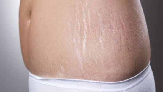 Stretch Marks Home Remedies