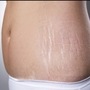 Stretch Marks Home Remedies