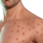 Mpox Disease Mpox Disease